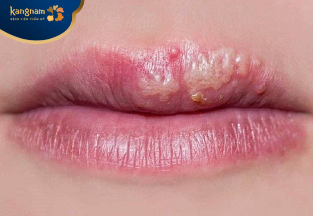 Tiêm filler bị mụn nước do nhiều nguyên nhân khác nhau