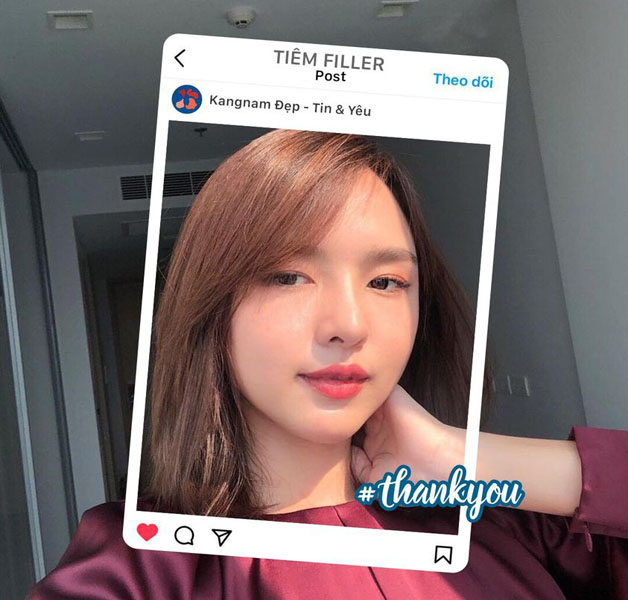 Kết quả tiêm filler đẹp tự nhiên