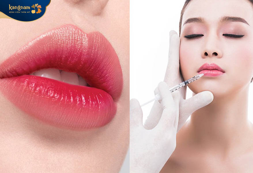 Tiêm filler môi có thể duy trì được từ 6 - 24 tháng
