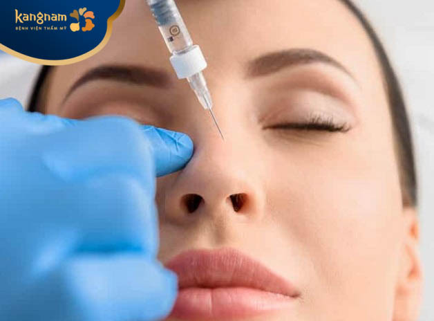 Kỹ thuật tiêm filler không chính xác