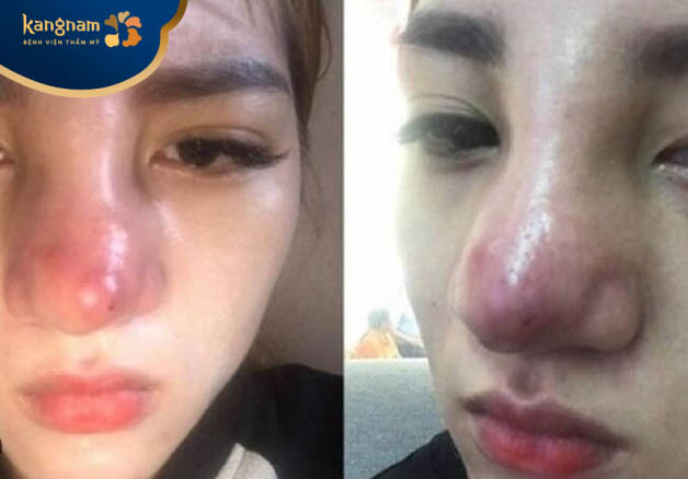 Biến chứng khi tiêm filler mũi tại cơ sở kém chất lượng