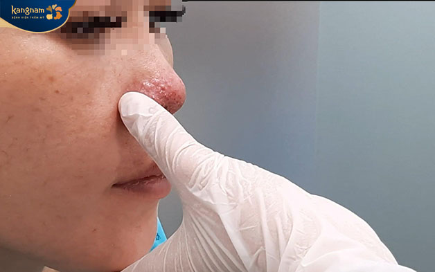 Mụn viêm, mụn mủ hình thành do tác dụng phụ khi tiêm filler cần cẩn thận điều trị 