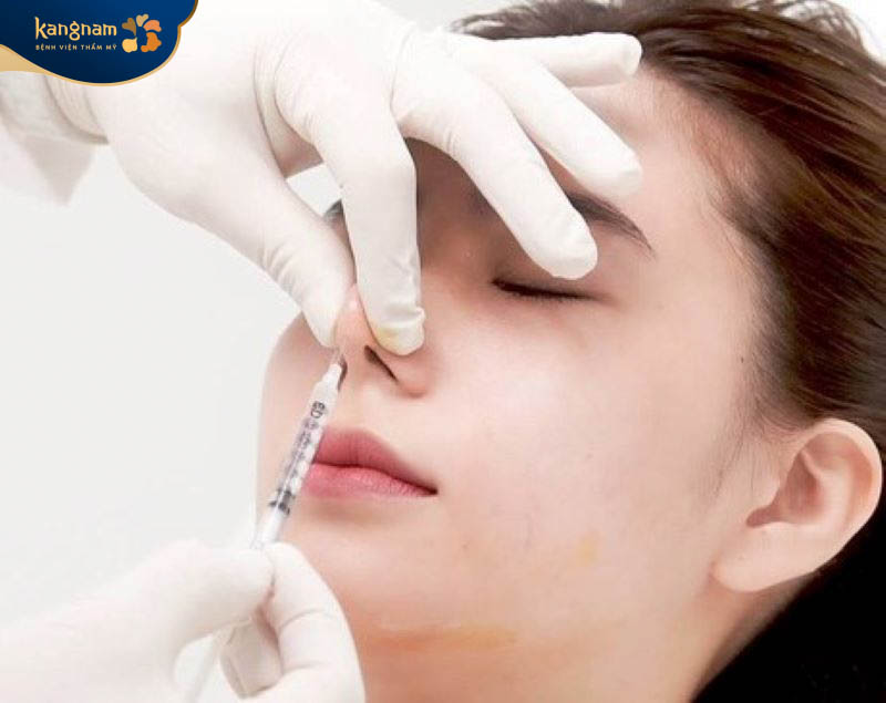 Tiêm filler mũi duy trì được từ 6 - 24 tháng
