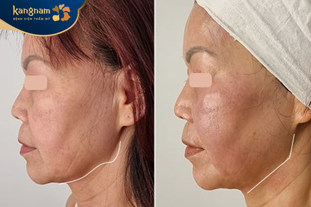 Trẻ hóa da công nghệ cao, hiệu quả rõ rệt