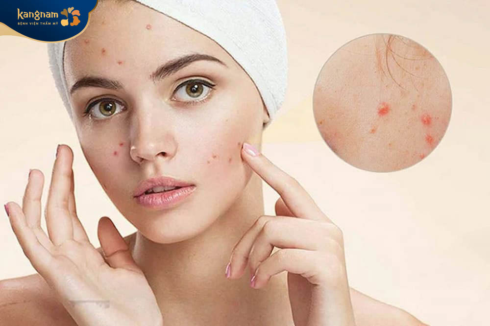 Mụn viêm thâm là dạng mụn trứng cá nặng, gây thâm sau viêm