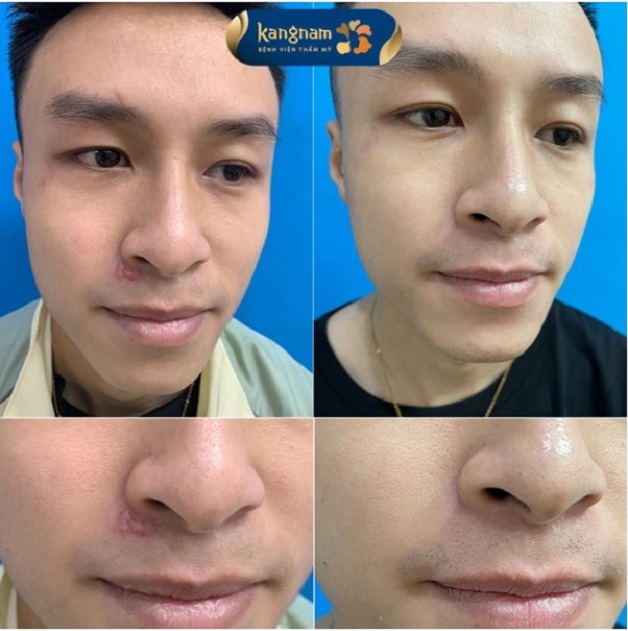Anh Quang trị sẹo lồi dưới cánh mũi tại Kangnam 