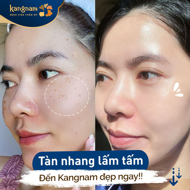 Trị tàn nhang bằng Laser Toning