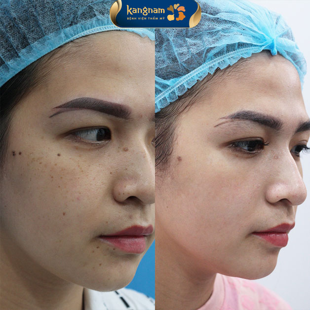 Xóa tàn nhang lâu năm nhanh chóng, triệt để