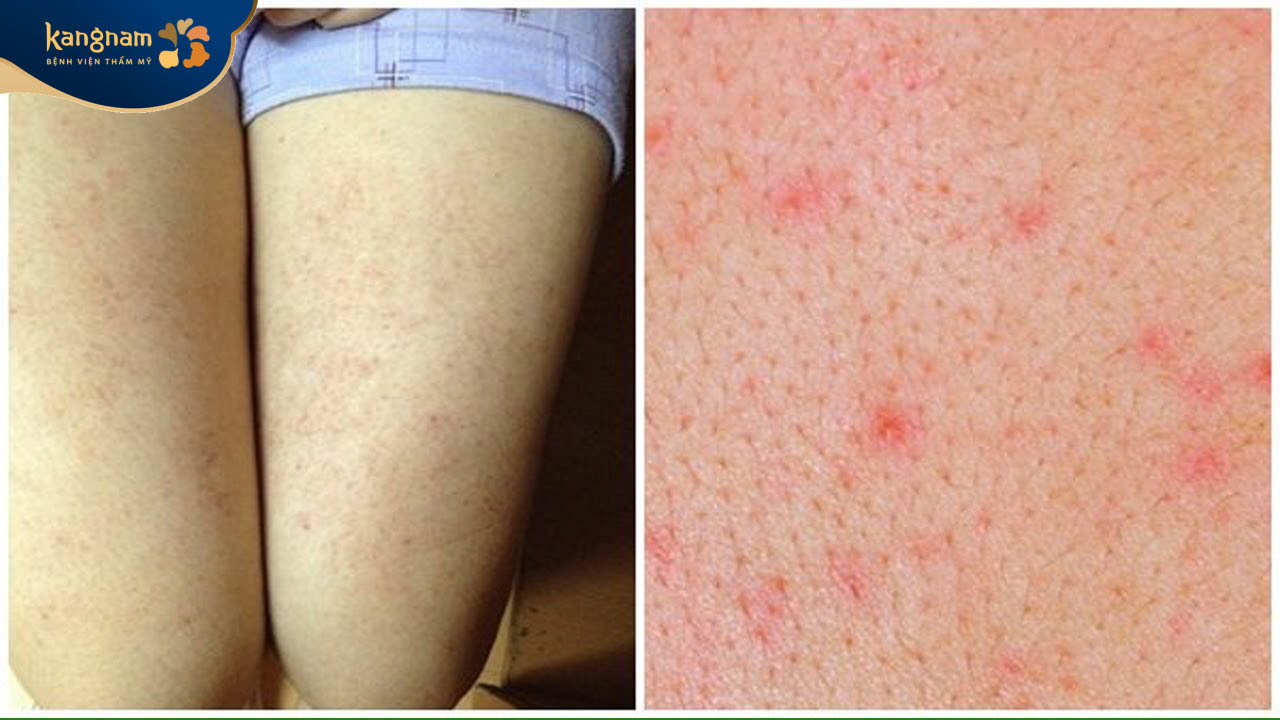 Nang lông bị viêm nhiễm nổi mụn