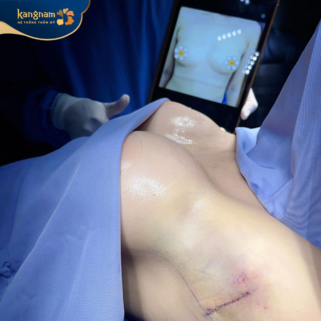 Quá trình nâng ngực nhẹ nhàng, giảm thiểu xâm lấn