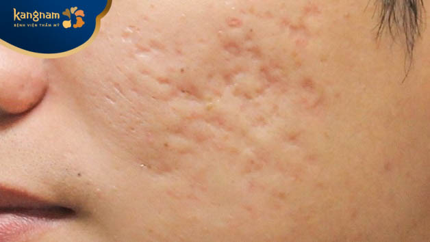 Điều trị sẹo lõm trên mặt lâu năm có khó không