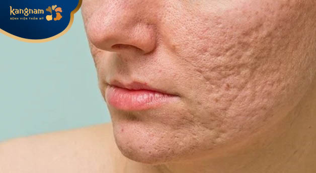 Sẹo lõm lâu năm thường khó điều trị hoàn toàn bằng phương pháp tự nhiên tại nhà