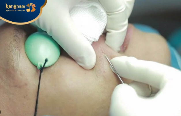 Phương pháp bóc tách sẹo (Subcision)