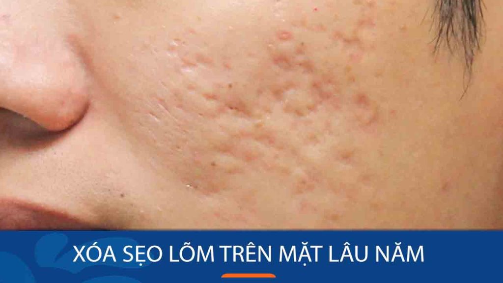 6 Cách Xóa Sẹo Lõm Trên Mặt Lâu Năm Hiệu Quả Tại Nhà