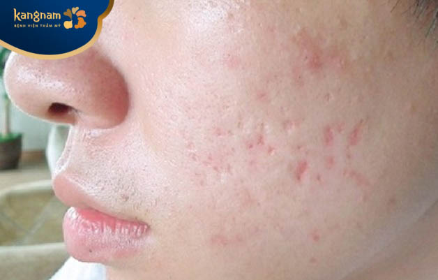 Sẹo lõm trên mặt lâu năm trên mặt có thể xóa được