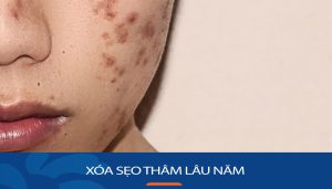 15 Bí Quyết Xóa Sạch Sẹo Thâm Lâu Năm, Da Trắng Mịn Nhanh Chóng
