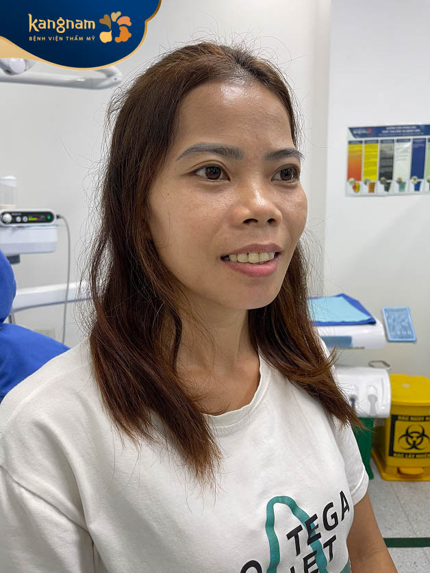 Khuôn mặt của Nhì sau 20 ngày