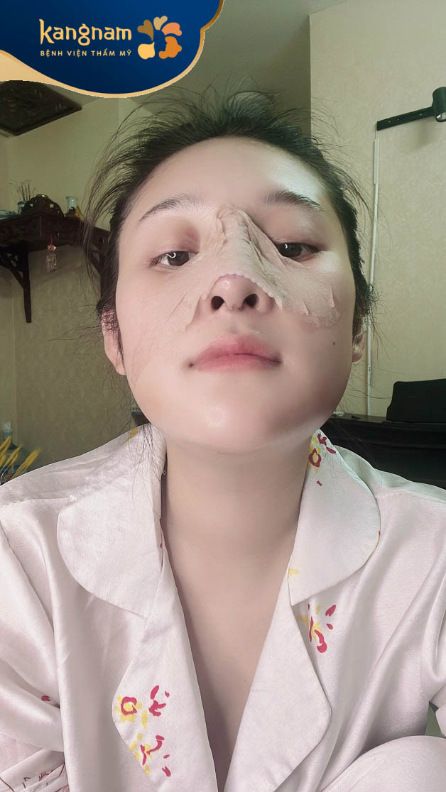 5 ngày sau phẫu thuật