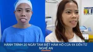 Hành trình 20 ngày thay đổi, tạm biệt hàm hô của 9x đến từ Nghệ An