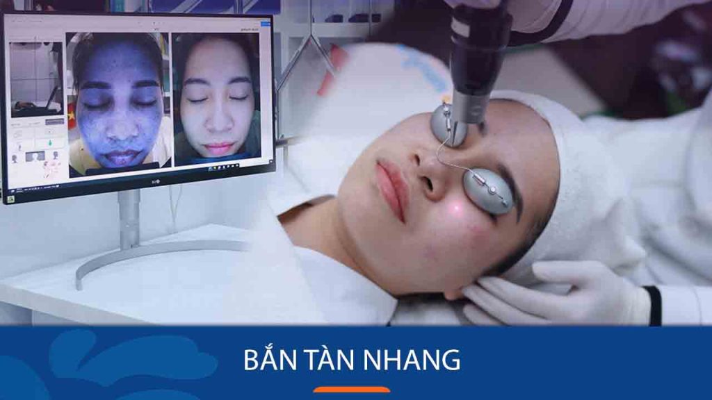 Bắn tàn nhang bằng laser – Lưu ý sau bắn laser loại bỏ tàn nhang