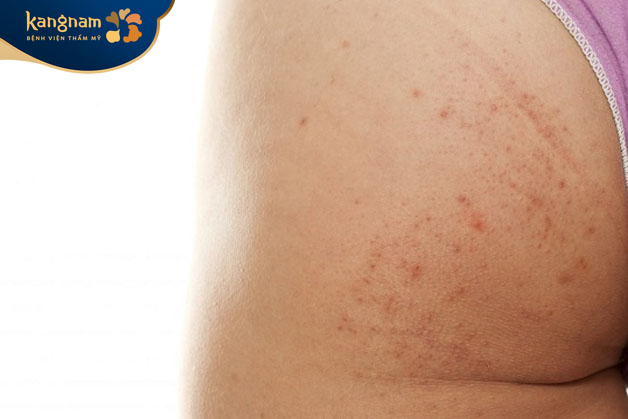 Mụn ở mông có thể xuất hiện do bệnh lý về da