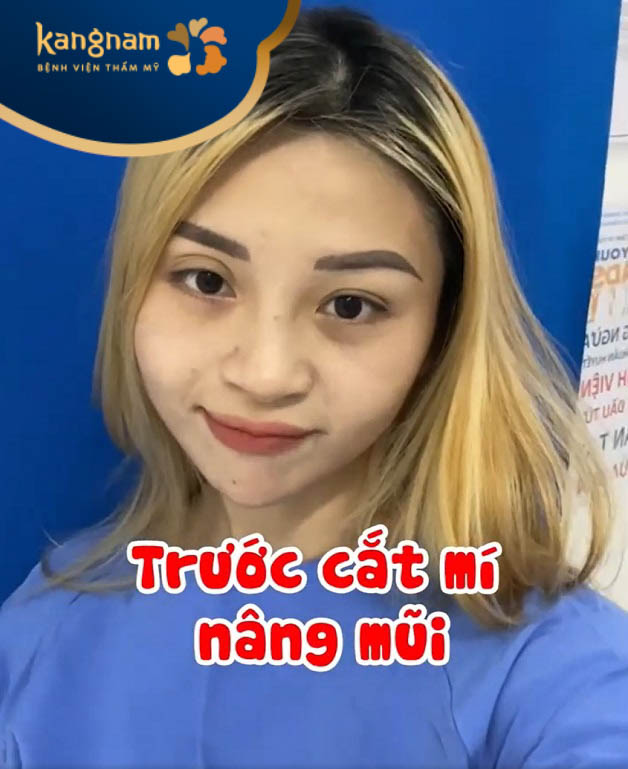 Bông Trần trước khi cắt mí, nâng mũi