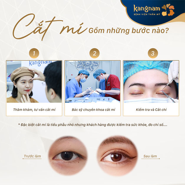 Tóm tắt quy trình cắt mí an toàn tại Kangnam