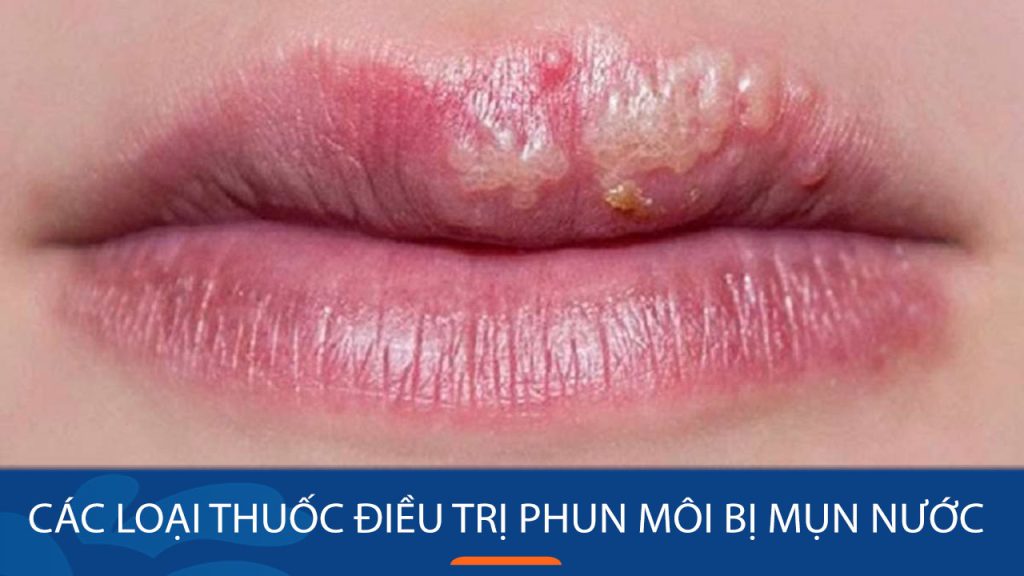 Các loại thuốc điều trị phun môi bị mụn nước hiệu quả nhất!