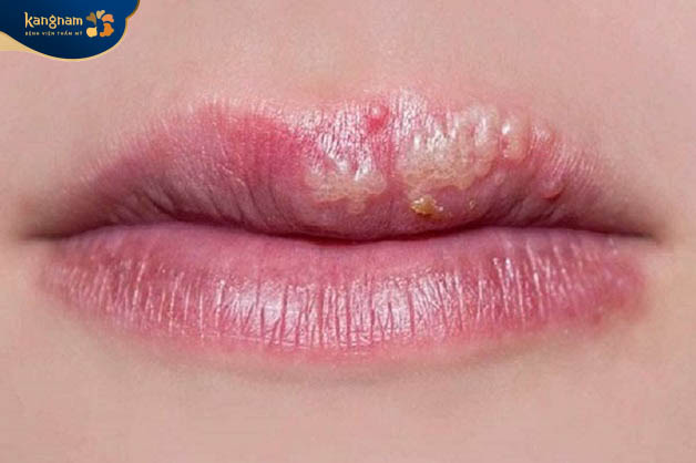 Phun môi bị nổi mụn nước do kỹ thuật thực hiện sai, không đảm bảo chất lượng, cách chăm sóc không cẩn thận