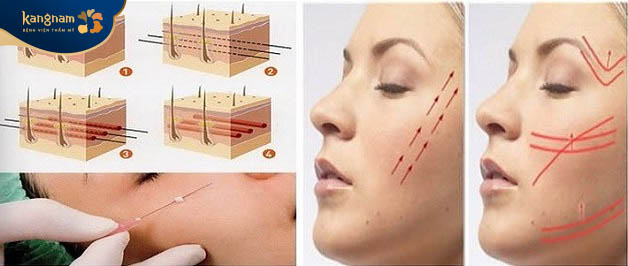 Căng chỉ da mặt được đánh giá là an toàn, không gây hại