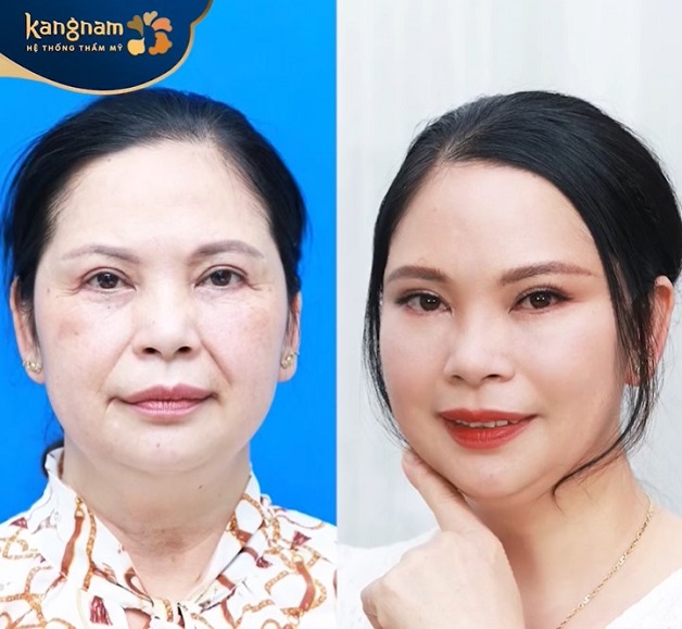 Gương mặt thon gọn, mờ nếp nhăn, da căng bóng