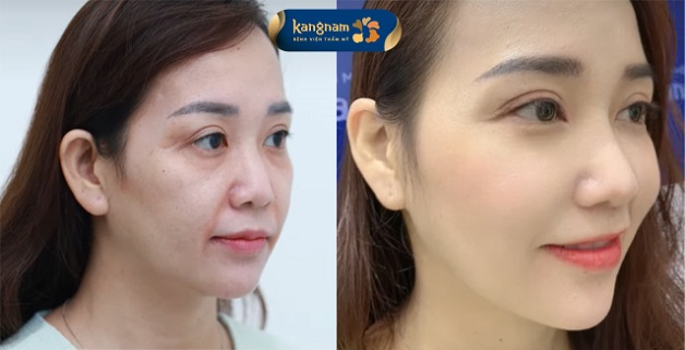 Da căng mịn, loại bỏ rãnh cười sau căng chỉ