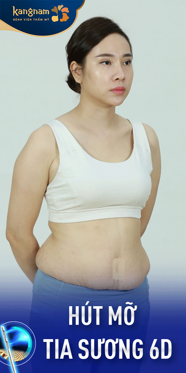 Thân hình quá khổ của nữ diễn viên trước khi áp dụng giảm mỡ 6D tia sương