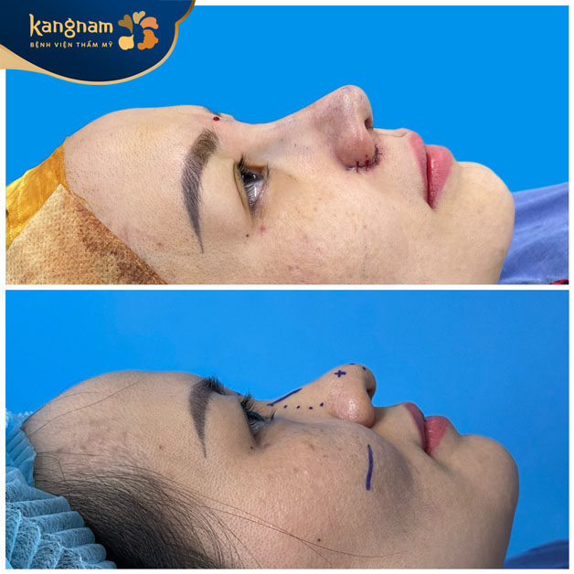 Kangnam là địa chỉ cắt cánh mũi uy tín tại Bình Dương