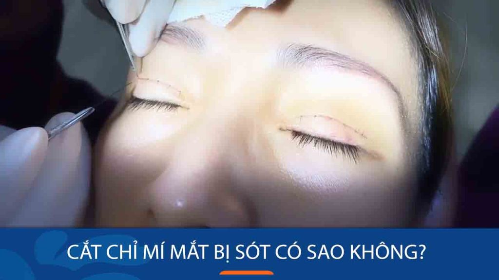 Cắt chỉ mí mắt bị sót có sao không? Có nguy hiểm không và cách xử lý an toàn