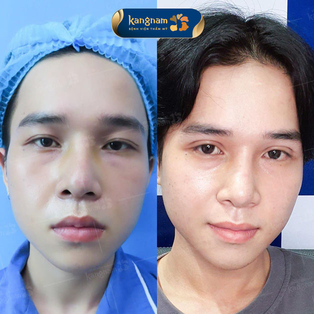 Cắt mí nam tăng thần thái cho gương mặt, nổi mặt các đường nét nam tính