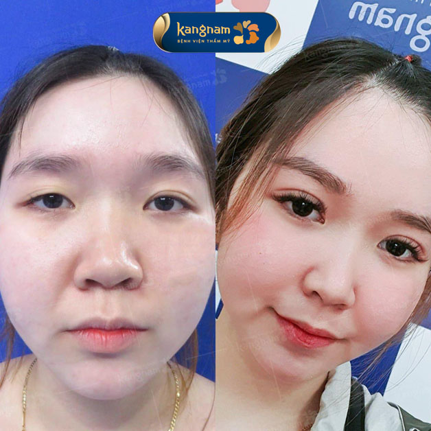 Cắt mí siêu tự nhiên, giúp thần sắc tươi tắn, rạng rỡ hơn