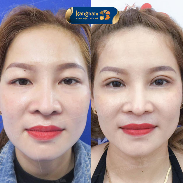 Khắc phục mắt sụp mí toàn diện, giúp gương mặt rạng rỡ hơn