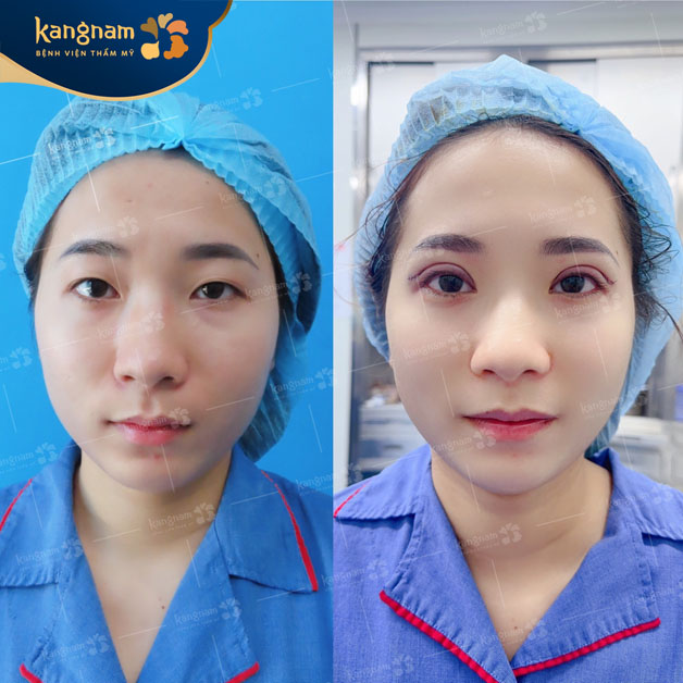 Cắt mí mới thực hiện xong không sưng nhiều, nếp mí rõ ràng