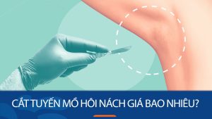 Cắt tuyến mồ hôi nách giá bao nhiêu? Các yếu tố quyết định chi phí