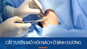 Địa chỉ cắt tuyến mồ hôi nách ở Bình Dương uy tín