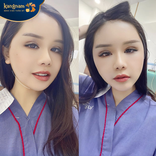 Cấy mỡ mặt tự thân được bao lâu