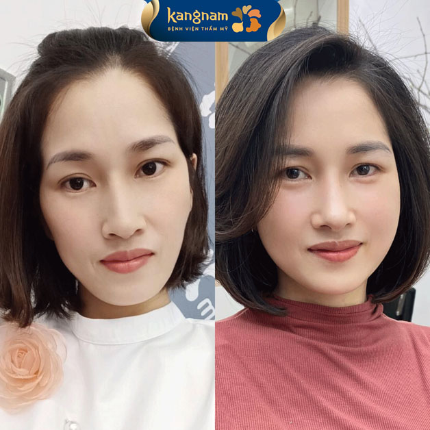 Cấy mỡ tự thân duy trì được khoảng 1-2 năm