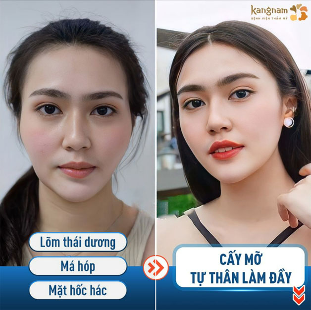 Giải quyết toàn diện các khuyết điểm chưa hài lòng trên gương mặt bằng mỡ tự thân