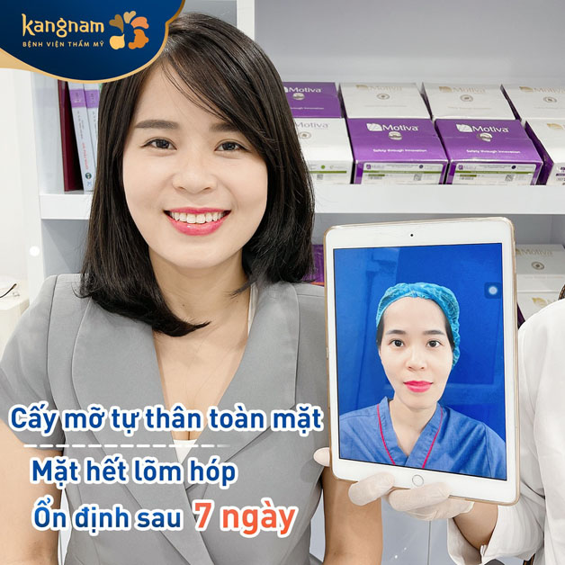 Cấy mỡ mặt tự thân được bao lâu