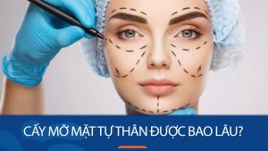 Cấy mỡ mặt tự thân được bao lâu? 5 cách duy trì vẻ đẹp thẩm mỹ