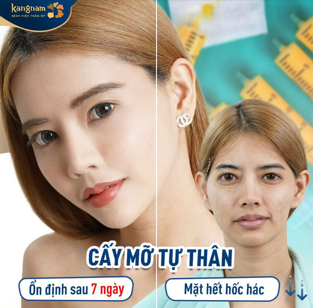 Hết hốc hác, già nua sau khi cấy mỡ tự thân tại Kangnam