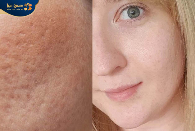 Mặt bị sẹo rỗ do mụn, thủy đậu