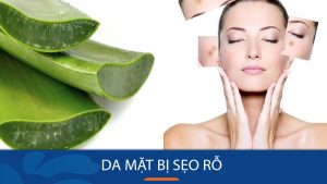 Bí quyết đánh bay sẹo rỗ tận gốc, lấy lại làn da mịn màng