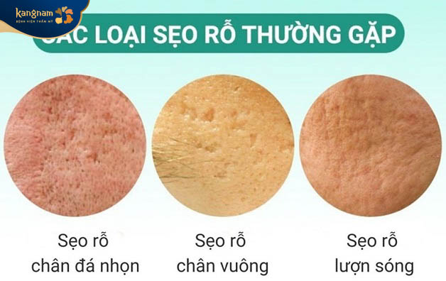 Những loại sẹo rỗ thường gặp